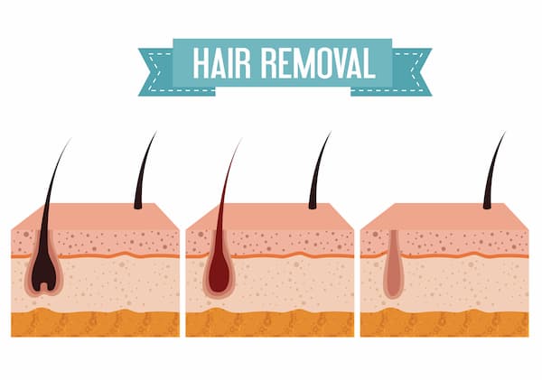 hair folicules before and after laser hair removal
