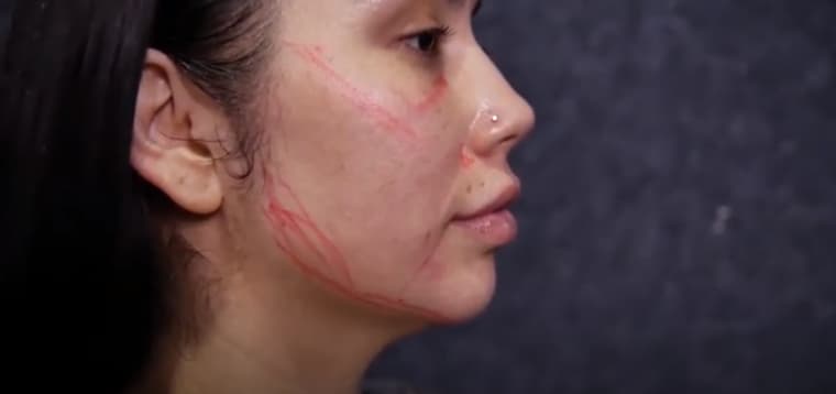 woman getting juvederm injections on her cheeks