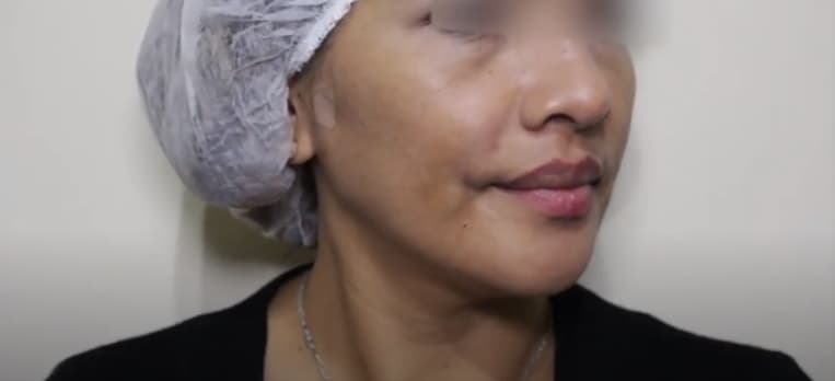 woman face afterjuvederm laugh line injections
