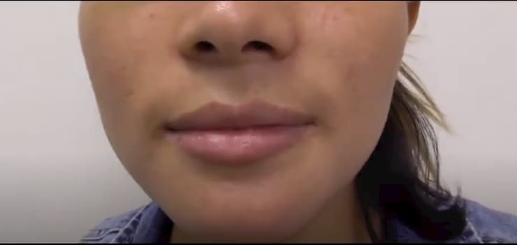 Woman's lips before juvederm lip injections