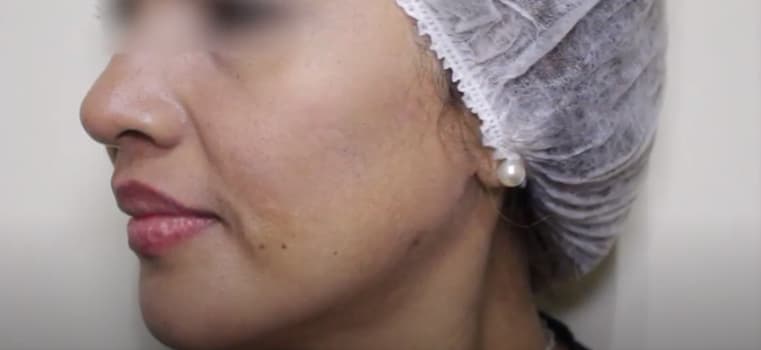 woman face before juvederm laugh line injections
