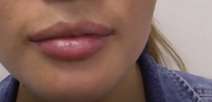 woman's lips after juvederm lip injections