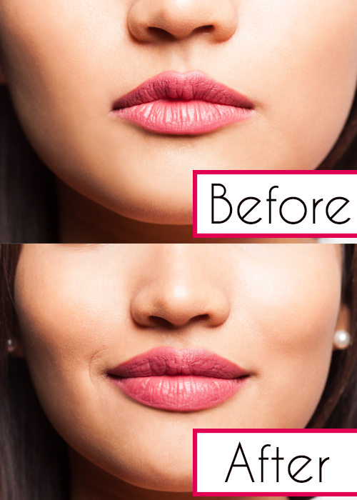 jucederm lip injections in ny before and after